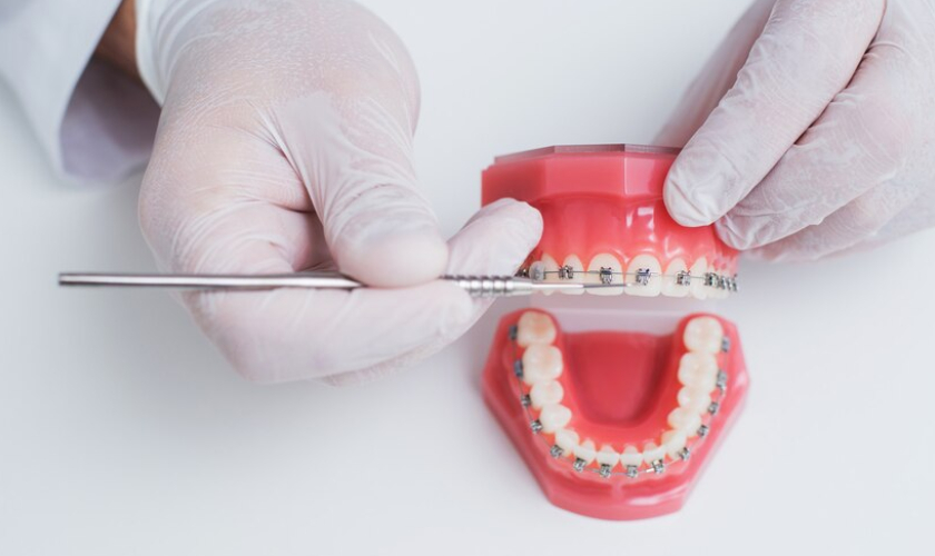Braces