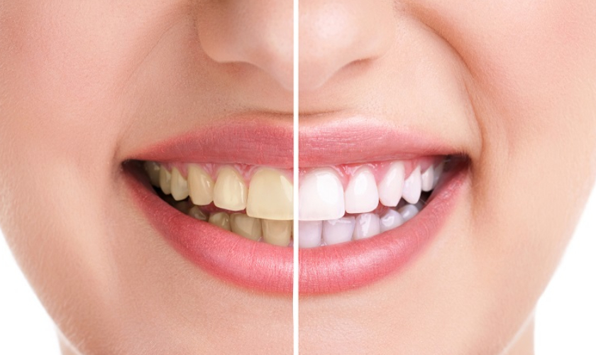 Teeth Whitening