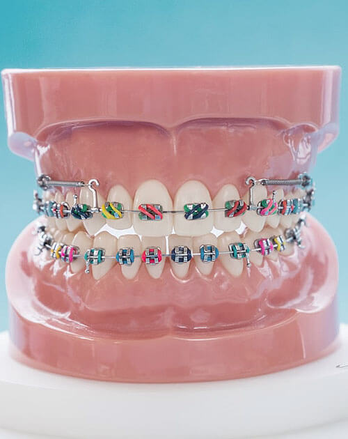 Damon-braces