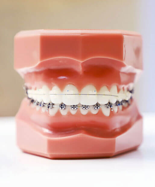 Damon-braces