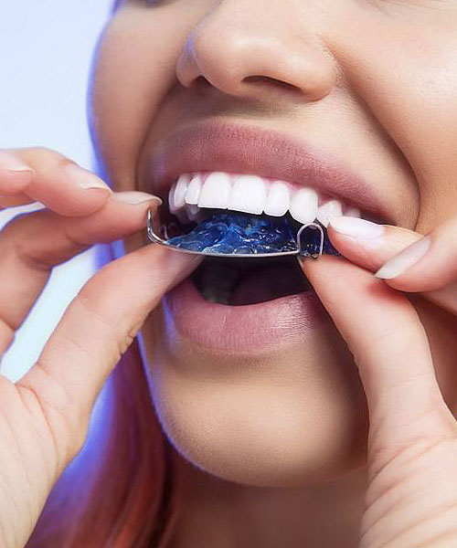 Vivera-Retainers