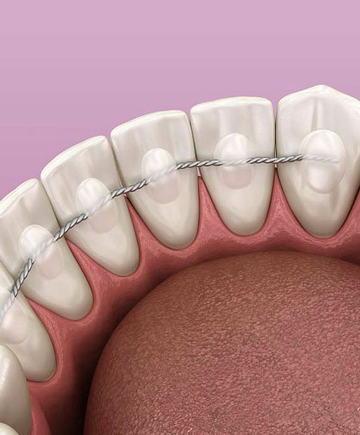 Retainers