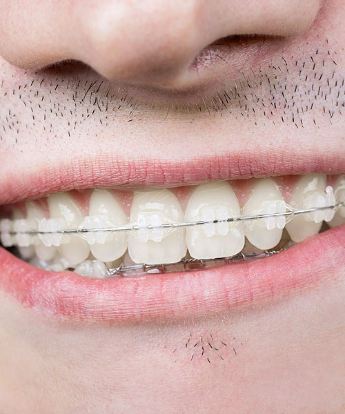 Vivera-Retainers