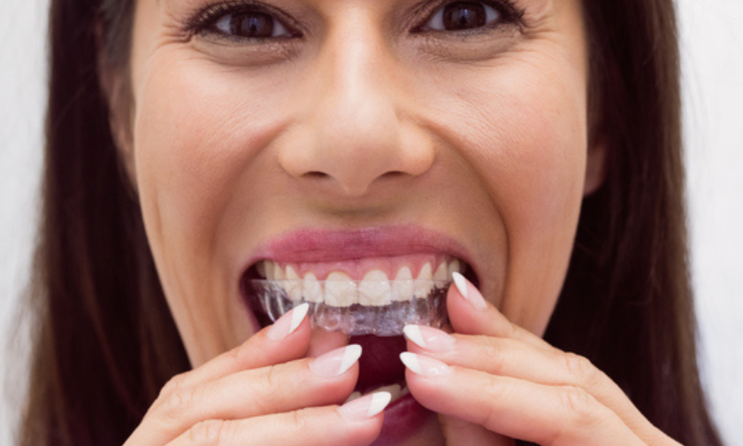 Invisalign for Teens and Adults