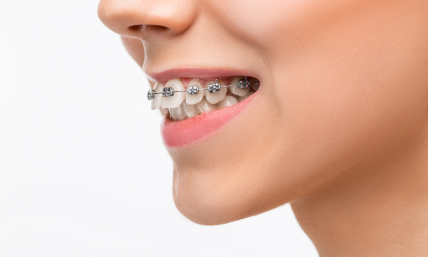 Damon Braces For Adults