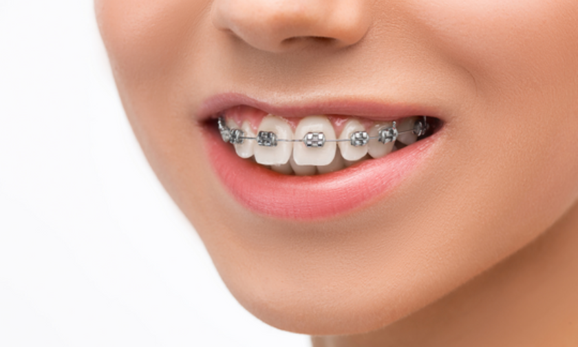 Clear Braces in Orange Park