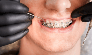 Braces in Orange Park