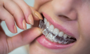 Invisalign Orange Park